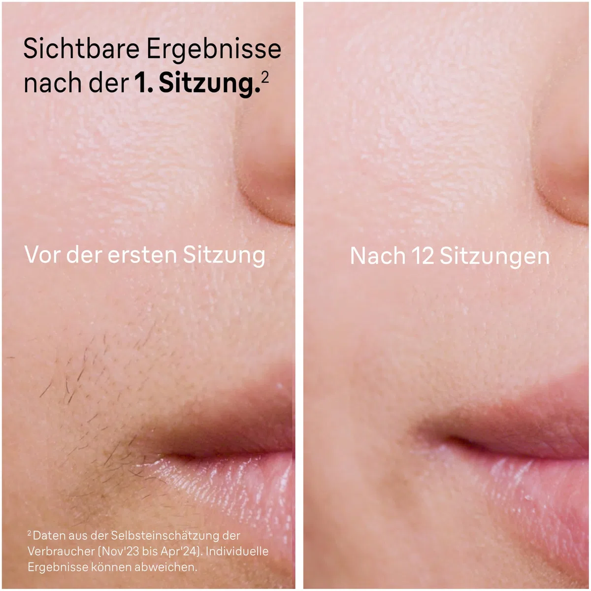 Braun Smart IPL Geräte Haarentfernung Skin i·expert 7, PL7147, Weiß/Rosegold - Alternative Laser Haarentfernung für Zuhause, Dauerhafte Haarentfernung, Inkl. Etui, Venus Rasierer Und 2 Aufsätze