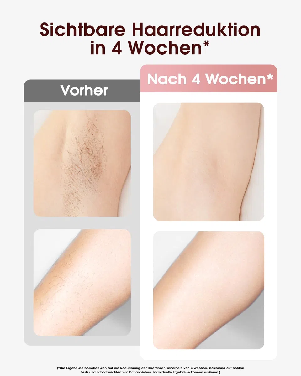 Haarlosy IPL Geräte Haarentfernung mit Kühlfunktion, 999,900 Lichtimpulse, 5 Energiestufen Schmerzfreie IPL Haarentfernung Laser Hair Removal für Frauen, Männer, Intimbereich, Körper und Beine - Rose