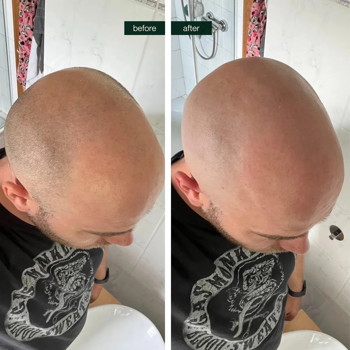BETTER BE BOLD I "Bold Shaver Set 3.0 - Glatzenrasierer + After Shave Glatzenpflege 2.0 I Set gegen Glanz, Pigmentflecken & Trockenheit – Mit Glatzencreme, Glatzenpeeling, Shampoo & Aftershave